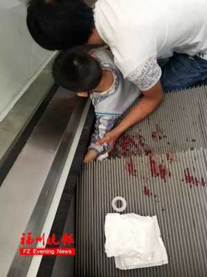 5岁女童电梯摔伤（小孩在电梯上摔倒）